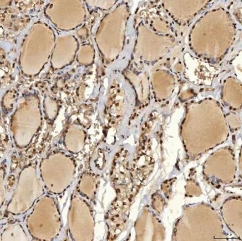 IHC staining of FFPE human thyroid papillary carcinoma tissue with Sm-D2 antibody. HIER: boil tissue sections in pH8 EDTA for 20 min and allow to cool before testing.