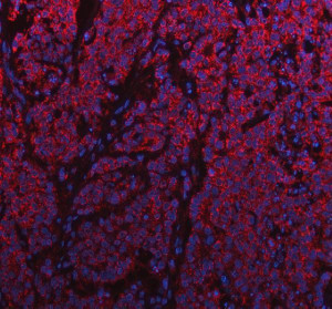 SNX9 Antibody Human Intestine Cancer IF. Immunofluorescent staining of FFPE human intestine cancer tissue with SNX9 Antibody at 5 ug/ml. HIER was performed using pH 8 EDTA buffer, followed by blocking with 10% goat serum. The tissue section was incubated with rabbit anti-SNX9 antibody overnight at 4Â°C, followed by Cy conjugated goat anti-rabbit IgG secondary antibody (red). Nuclei were counterstained with DAPI (blue). SNX9 Antibody, an endocytic trafficking protein marker, demonstrates cytoplasmic staining consistent with its role in vesicle transport, membrane remodeling and intracellular trafficking pathways.
