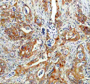 SNX9 Antibody Human Colon Cancer IHC. IHC staining of FFPE human colon cancer tissue with SNX9 Antibody at 2 ug/ml. HIER was performed using pH 8 EDTA buffer, followed by blocking with 10% goat serum. The tissue section was incubated with rabbit anti-SNX9 antibody overnight at 4Â°C, followed by HRP-conjugated goat anti-rabbit IgG secondary antibody and DAB chromogen detection. SNX9 Antibody, an endocytic trafficking protein marker, shows cytoplasmic staining in tumor cells consistent with its role in membrane remodeling, vesicle transport and intracellular trafficking regulation.