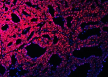 Immunofluorescent staining of FFPE human ovarian cancer with OTT3 antibody (red) and DAPI nuclear stain (blue). HIER: steam section in pH6 citrate buffer for 20 min.