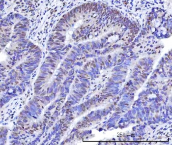 IHC staining of FFPE human rectum adenocarcinoma tissue with OTT3 antibody. HIER: boil tissue sections in pH8 EDTA for 20 min and allow to cool before testing.