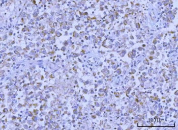 IHC staining of FFPE human testicular seminoma tissue with Hamartin antibody. HIER: boil tissue sections in pH8 EDTA for 20 min and allow to cool before testing.