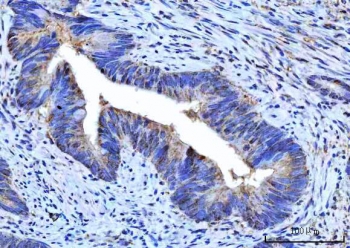 IHC staining of FFPE human rectum adenocarcinoma tissue with Small ribosomal subunit protein uS7 antibody. HIER: boil tissue sections in pH8 EDTA for 20 min and allow to cool before testing.