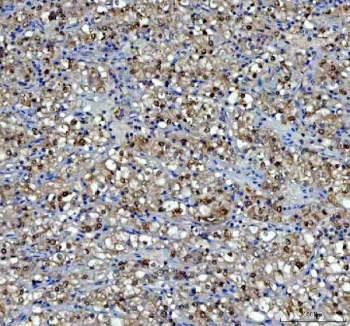 IHC staining of FFPE human glioblastoma tissue with P15RS antibody. HIER: boil tissue sections in pH8 EDTA for 20 min and allow to cool before testing.