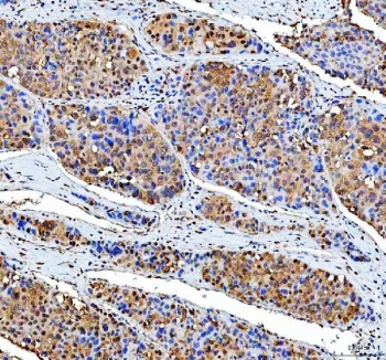IHC staining of FFPE human liver cancer tissue with P15RS antibody. HIER: boil tissue sections in pH8 EDTA for 20 min and allow to cool before testing.
