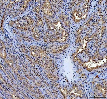 IHC staining of FFPE human thyroid papillary carcinoma tissue with P15RS antibody. HIER: boil tissue sections in pH8 EDTA for 20 min and allow to cool before testing.