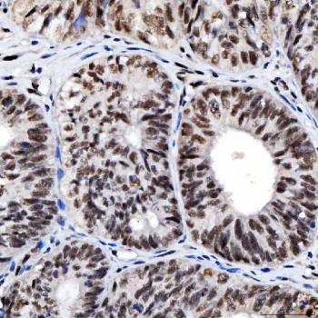 IHC staining of FFPE human endometrioid adenocarcinoma tissue with SNRNP200 antibody. HIER: boil tissue sections in pH8 EDTA for 20 min and allow to cool before testing.