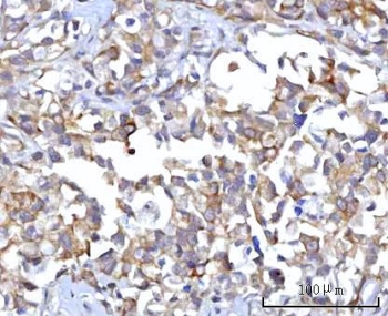 IHC staining of FFPE human gastric adenocarcinoma tissue with RAP1GAP antibody. HIER: boil tissue sections in pH8 EDTA for 20 min and allow to cool before testing.