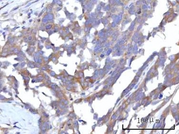 IHC staining of FFPE human ovary serous carcinoma tissue with RAP1GAP antibody. HIER: boil tissue sections in pH8 EDTA for 20 min and allow to cool before testing.