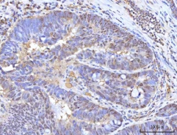 IHC staining of FFPE human rectum adenocarcinoma tissue with RANBP2 antibody. HIER: boil tissue sections in pH8 EDTA for 20 min and allow to cool before testing.