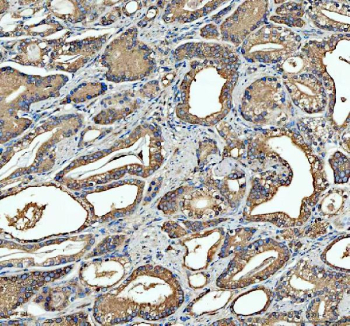 Immunohistochemical staining of FFPE human prostate cancer tissue with SGSH antibody, HRP-secondary and DAB substrate. HIER: boil tissue sections in pH8 EDTA for 20 min and allow to cool before testing.