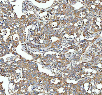 Immunohistochemical staining of FFPE human breast cancer tissue with SGSH antibody, HRP-secondary and DAB substrate. HIER: boil tissue sections in pH8 EDTA for 20 min and allow to cool before testing.