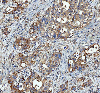 Immunohistochemical staining of FFPE human appendiceal adenocarcinoma tissue with SGSH antibody, HRP-secondary and DAB substrate. HIER: boil tissue sections in pH8 EDTA for 20 min and allow to cool before testing.