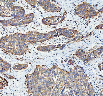 Immunohistochemical staining of FFPE human urothelium carcinoma tissue with SGSH antibody, HRP-secondary and DAB substrate. HIER: boil tissue sections in pH8 EDTA for 20 min and allow to cool before testing.
