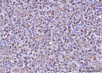 IHC staining of FFPE human testicular seminoma tissue with RNF34 antibody. HIER: boil tissue sections in pH8 EDTA for 20 min and allow to cool before testing.