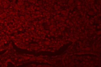 Immunofluorescent staining of FFPE human lung cancer tissue with RNF40 antibody (red). HIER: steam section in pH8 EDTA buffer for 20 min.