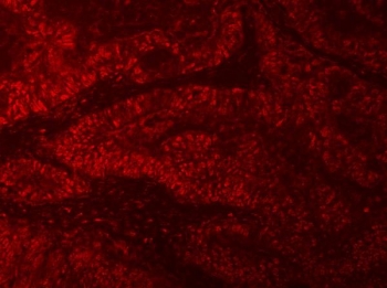 Immunofluorescent staining of FFPE human colon cancer tissue with mRNA-capping enzyme antibody (red). HIER: steam section in pH8 EDTA buffer for 20 min.