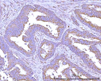 IHC staining of FFPE human colon adenocarcinoma tissue with RPS15A antibody. HIER: boil tissue sections in pH8 EDTA for 20 min and allow to cool before testing.