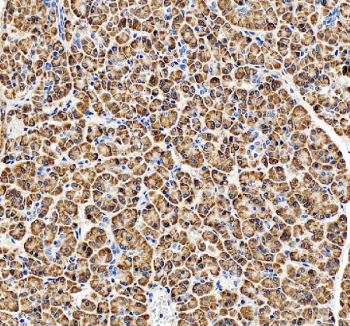 IHC staining of FFPE human pancreatic cancer tissue with Ribophorin II antibody, HRP-secondary and DAB substrate. HIER: boil tissue sections in pH8 EDTA for 20 min and allow to cool before testing.