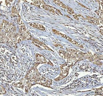 IHC staining of FFPE human parotid acinar cell carcinoma tissue with RTCB antibody. HIER: boil tissue sections in pH8 EDTA for 20 min and allow to cool before testing.