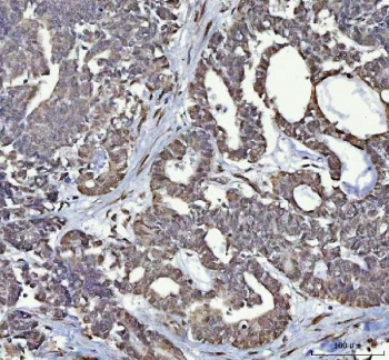 IHC staining of FFPE human ovarian cancer tissue with RTCB antibody. HIER: boil tissue sections in pH8 EDTA for 20 min and allow to cool before testing.