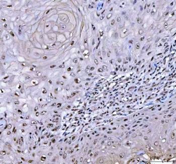 IHC staining of FFPE human skin squamous cell carcinoma tissue with RTCB antibody. HIER: boil tissue sections in pH8 EDTA for 20 min and allow to cool before testing.