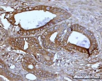 IHC staining of FFPE human colon adenocarcinoma tissue with SSBP1 antibody. HIER: boil tissue sections in pH8 EDTA for 20 min and allow to cool before testing.
