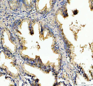 PDXDC1 Antibody Human Prostate Cancer IHC. Immunohistochemistry staining of FFPE human prostate cancer tissue with PDXDC1 Antibody at 2 ug/ml. HIER was performed using pH 8 EDTA buffer, followed by blocking with 10% goat serum. The tissue section was incubated with rabbit anti-PDXDC1 antibody overnight at 4Â°C, followed by HRP-conjugated goat anti-rabbit IgG secondary antibody and DAB chromogen detection. PDXDC1 Antibody / Pyridoxal Decarboxylase Domain Protein Antibody demonstrates cytoplasmic staining in prostate cancer cells and supports studies of pyridoxal-dependent enzyme domain proteins, cellular metabolism and cancer-associated cellular pathways.