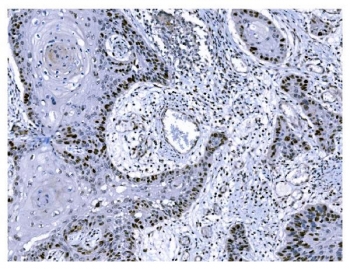 IHC staining of FFPE human esophageal squamous carcinoma tissue with Ki67 antibody. HIER: boil tissue sections in pH8 EDTA for 20 min and allow to cool before testing.