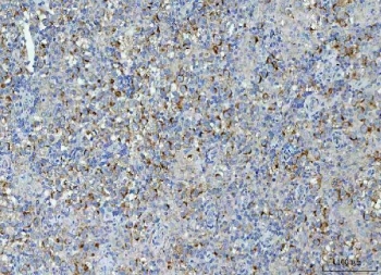 TMEM87A Antibody Human Testicular Seminoma IHC. Immunohistochemical staining of FFPE human testicular seminoma tissue using TMEM87A Antibody / Transmembrane Protein 87A Antibody. Heat-induced epitope retrieval was performed using pH8 EDTA buffer, followed by HRP-conjugated secondary antibody detection and DAB chromogen. Diffuse cytoplasmic and membranous staining is observed throughout the seminoma cells, consistent with expression of the transmembrane protein TMEM87A. This TMEM87A Antibody, also called Transmembrane Protein 87A Antibody, is suitable for studies of membrane protein expression, intracellular trafficking, cellular signaling, and tumor biology.