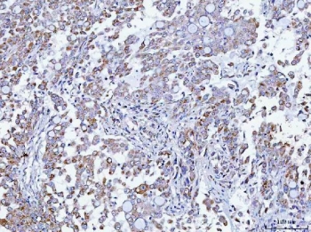 TMEM87A Antibody Human Lung Adenocarcinoma IHC. Immunohistochemical staining of FFPE human lung adenocarcinoma tissue using TMEM87A Antibody / Transmembrane Protein 87A Antibody. Heat-induced epitope retrieval was performed using pH8 EDTA buffer, followed by HRP-conjugated secondary antibody detection and DAB chromogen. Moderate cytoplasmic and membranous staining is observed in the tumor cells, consistent with the expected localization of TMEM87A. This TMEM87A Antibody, also called Transmembrane Protein 87A Antibody, is suitable for studies of membrane protein expression, intracellular trafficking, cellular signaling, and cancer biology.