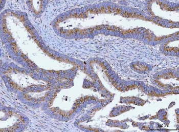 TMEM87A Antibody Human Colon Adenocarcinoma IHC. Immunohistochemical staining of FFPE human colon adenocarcinoma tissue using TMEM87A Antibody / Transmembrane Protein 87A Antibody. Heat-induced epitope retrieval was performed using pH8 EDTA buffer, followed by HRP-conjugated secondary antibody detection and DAB chromogen. Predominantly membranous and cytoplasmic staining is observed in the glandular tumor epithelium, consistent with the expected localization of TMEM87A. This TMEM87A Antibody, also called Transmembrane Protein 87A Antibody, is suitable for studies of membrane protein expression, intracellular trafficking, epithelial biology, and cancer research.