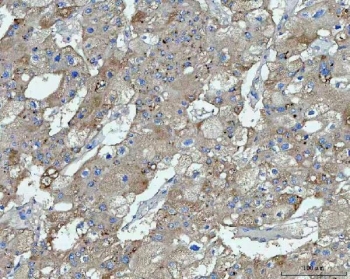TMEM87A Antibody Human Liver Cancer IHC. Immunohistochemical staining of FFPE human liver cancer tissue using TMEM87A Antibody / Transmembrane Protein 87A Antibody. Heat-induced epitope retrieval was performed using pH8 EDTA buffer, followed by HRP-conjugated secondary antibody detection and DAB chromogen. Moderate diffuse cytoplasmic staining is observed throughout the tumor cells, with occasional membranous accentuation, consistent with the expected localization of TMEM87A. This TMEM87A Antibody, also called Transmembrane Protein 87A Antibody, is suitable for studies of membrane protein expression, intracellular trafficking, cellular signaling, and cancer biology.