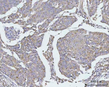 TMEM87A Antibody Human Esophageal Squamous Carcinoma IHC. Immunohistochemical staining of FFPE human esophageal squamous carcinoma tissue using TMEM87A Antibody / Transmembrane Protein 87A Antibody. Heat-induced epitope retrieval was performed using pH8 EDTA buffer, followed by HRP-conjugated secondary antibody detection and DAB chromogen. Moderate cytoplasmic and membranous staining is observed throughout the squamous tumor cells, consistent with the expected localization of TMEM87A. This TMEM87A Antibody, also called Transmembrane Protein 87A Antibody, is suitable for studies of membrane protein expression, intracellular trafficking, cellular signaling, and squamous cell carcinoma biology.