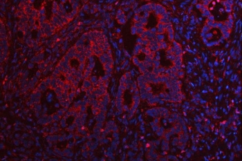 Immunofluorescent staining of FFPE human intestinal cancer tissue with TMEM132B antibody (red) and DAPI nuclear stain (blue). HIER: steam section in pH8 EDTA buffer for 20 min.