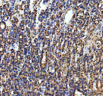 IHC staining of FFPE human thyroid cancer tissue with PGAM1 antibody, HRP-secondary and DAB substrate. HIER: boil tissue sections in pH8 EDTA for 20 min and allow to cool before testing.