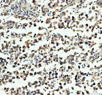 IHC staining of FFPE human testis cancer tissue with PGAM1 antibody, HRP-secondary and DAB substrate. HIER: boil tissue sections in pH8 EDTA for 20 min and allow to cool before testing.