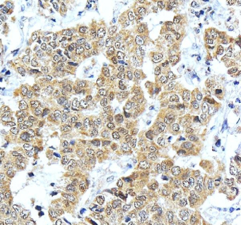 IHC staining of FFPE human liver cancer tissue with ONECUT1 antibody, HRP-secondary and DAB substrate. HIER: boil tissue sections in pH8 EDTA for 20 min and allow to cool before testing.
