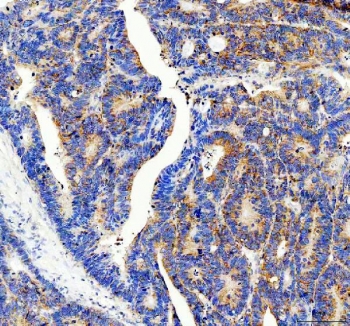 IHC staining of FFPE human colon cancer tissue with 40S ribosomal protein S14 antibody. HIER: boil tissue sections in pH8 EDTA for 20 min and allow to cool before testing.