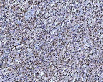 IHC staining of FFPE human B cell lymphoma tissue with RPRD1B antibody. HIER: boil tissue sections in pH8 EDTA for 20 min and allow to cool before testing.