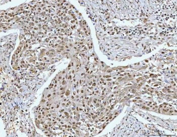 IHC staining of FFPE human esophageal squamous carcinoma tissue with RPRD1B antibody. HIER: boil tissue sections in pH8 EDTA for 20 min and allow to cool before testing.
