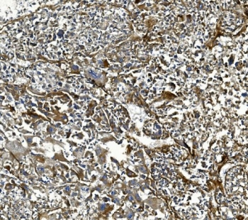 IHC staining of FFPE human liver cancer tissue with COL4A3 antibody. HIER: boil tissue sections in pH8 EDTA for 20 min and allow to cool before testing.