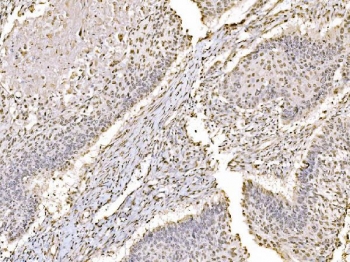 JUN Antibody Laryngeal Squamous Cell Carcinoma IHC. Immunohistochemical staining of FFPE human laryngeal squamous cell carcinoma tissue using JUN Antibody demonstrates predominantly nuclear HRP-DAB brown staining within malignant squamous epithelial cell populations. The staining pattern is consistent with expression of JUN (c-Jun), a key component of the AP-1 transcription factor complex that regulates gene expression involved in cellular proliferation, differentiation, stress responses, and tissue remodeling. Nuclear localization of JUN is consistent with its established role as a DNA-binding transcription factor that mediates signal-dependent transcriptional regulation and cellular adaptation. HIER: boil tissue sections in pH 8 EDTA buffer for 20 minutes and allow to cool before testing.
