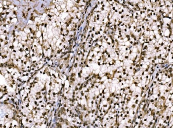 JUN Antibody Renal Clear Cell Carcinoma IHC. Immunohistochemical staining of FFPE human renal clear cell carcinoma tissue using JUN Antibody demonstrates strong nuclear HRP-DAB brown staining throughout neoplastic cell populations. The staining pattern is consistent with expression of JUN (c-Jun), a DNA-binding component of the AP-1 transcription factor complex that regulates gene expression involved in cellular proliferation, differentiation, stress responses, and signal-dependent transcriptional programs. The prominent nuclear localization observed within tumor cells is characteristic of an active transcription factor and supports the role of JUN in coordinating gene regulatory networks that influence cellular adaptation and tissue remodeling. HIER: boil tissue sections in pH 8 EDTA buffer for 20 minutes and allow to cool before testing.