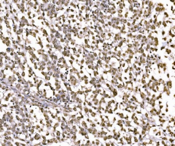 JUN Antibody Human Pancreatic Cancer IHC. Immunohistochemical staining of FFPE human pancreatic cancer tissue using JUN Antibody demonstrates extensive nuclear HRP-DAB brown staining throughout malignant epithelial cell populations. The staining pattern is consistent with expression of JUN (c-Jun), a DNA-binding component of the AP-1 transcription factor complex that regulates gene expression involved in cellular proliferation, differentiation, stress responses, and signal-dependent transcriptional regulation. The predominantly nuclear localization observed within tumor cells is characteristic of a transcription factor actively engaged in gene regulatory processes and supports the role of JUN in coordinating transcriptional networks associated with cellular adaptation and tumor biology. HIER: boil tissue sections in pH 8 EDTA buffer for 20 minutes and allow to cool before testing.