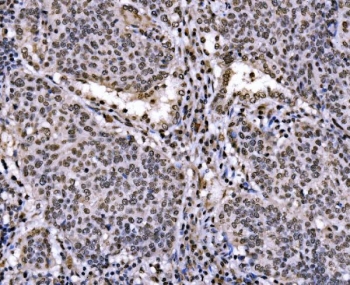 JUN Antibody Human Lung Cancer IHC. Immunohistochemical staining of FFPE human lung cancer tissue using JUN Antibody demonstrates widespread nuclear HRP-DAB brown staining throughout malignant tumor cell populations. The staining pattern is consistent with expression of JUN (c-Jun), a DNA-binding component of the AP-1 transcription factor complex that regulates gene expression involved in cellular proliferation, differentiation, stress responses, and signal-dependent transcriptional programs. The strong nuclear localization observed across neoplastic cells is characteristic of a transcription factor and supports the role of JUN in coordinating gene regulatory networks that influence cellular adaptation, growth, and tumor-associated signaling. HIER: boil tissue sections in pH 8 EDTA buffer for 20 minutes and allow to cool before testing.