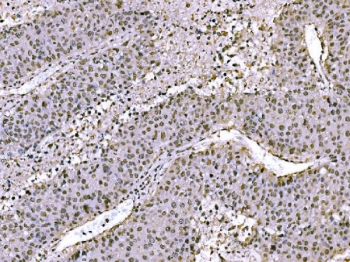JUN Antibody Human Liver Cancer IHC. Immunohistochemical staining of FFPE human liver cancer tissue using JUN Antibody demonstrates widespread nuclear HRP-DAB brown staining throughout malignant hepatocellular populations. The staining pattern is consistent with expression of JUN (c-Jun), a DNA-binding component of the AP-1 transcription factor complex that regulates gene expression involved in cellular proliferation, differentiation, stress responses, and signal-dependent transcriptional regulation. The predominantly nuclear localization observed within tumor cells is characteristic of an active transcription factor and supports the role of JUN in coordinating gene regulatory networks that govern cellular adaptation, growth control, and tissue remodeling. HIER: boil tissue sections in pH 8 EDTA buffer for 20 minutes and allow to cool before testing.