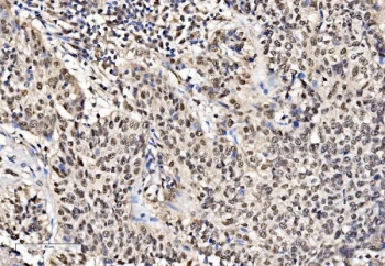 IHC staining of FFPE human lung cancer tissue with FUBP2 antibody. HIER: boil tissue sections in pH8 EDTA for 20 min and allow to cool before testing.