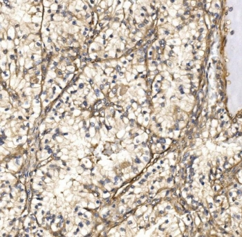 IHC staining of FFPE human renal clear cell carcinoma tissue with Nucleoredoxin antibody. HIER: boil tissue sections in pH8 EDTA for 20 min and allow to cool before testing.
