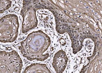 IHC staining of FFPE human esophageal squamous carcinoma tissue with CoREST antibody. HIER: boil tissue sections in pH8 EDTA for 20 min and allow to cool before testing.